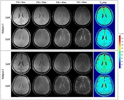Magnetic resonance T1ρ quantification of human brain at 5.0 T: A pilot study